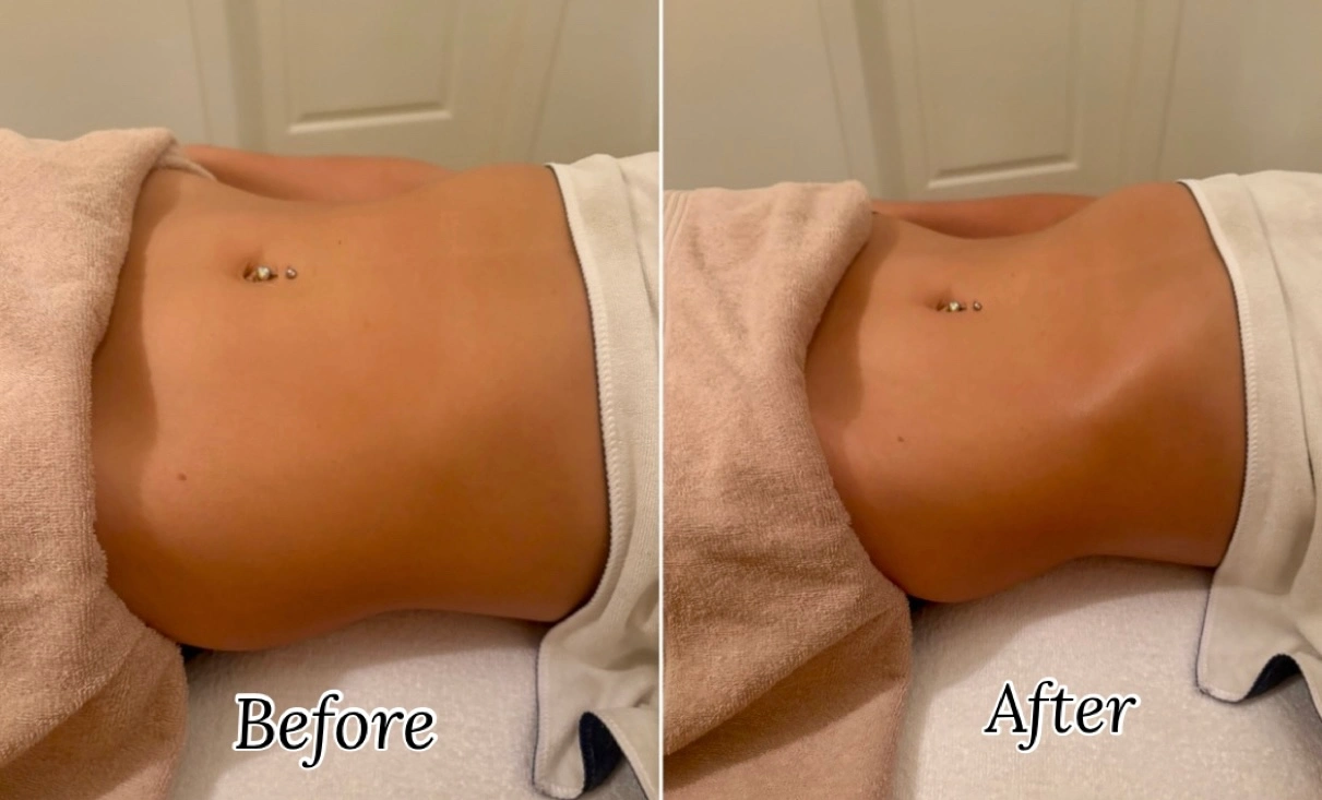 Before and after abdominal lymphatic drainage - approved client result