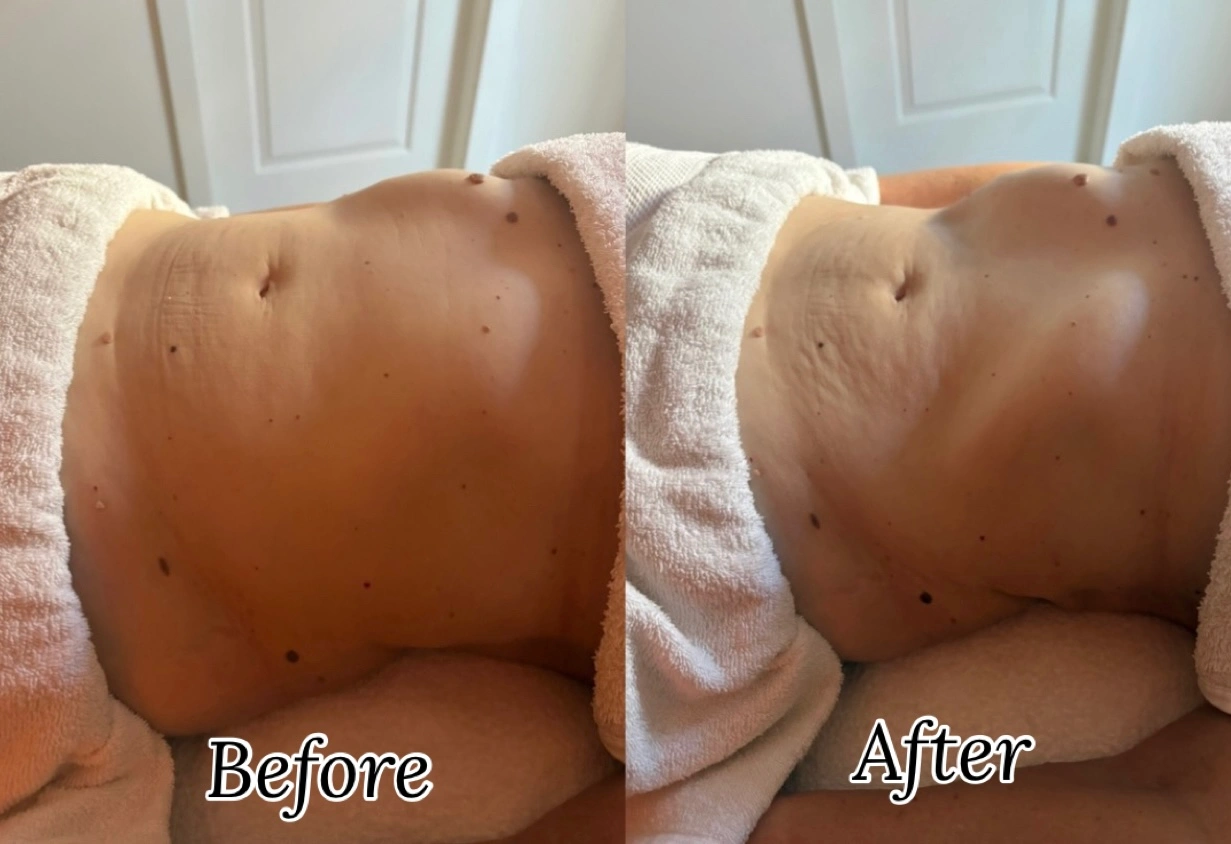 Before-and-after client result following lymphatic drainage treatment with Kate.