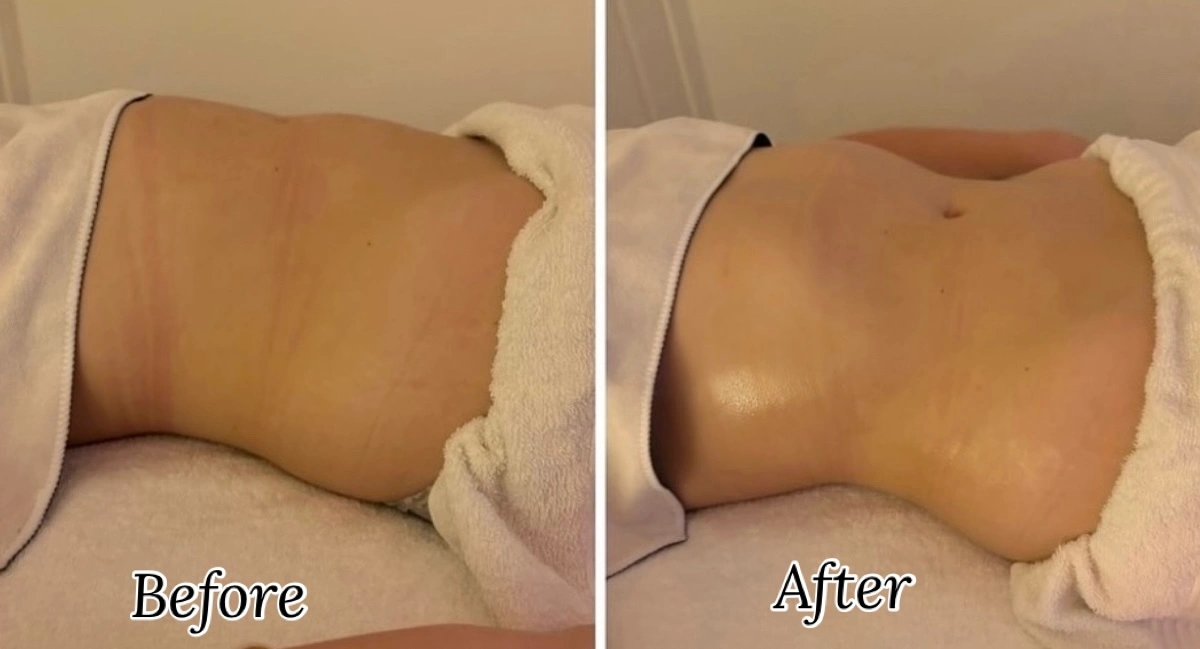 Before-and-after client result following lymphatic drainage treatment with Kate.