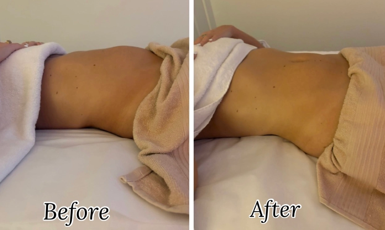 Before-and-after client result following lymphatic drainage treatment with Kate.