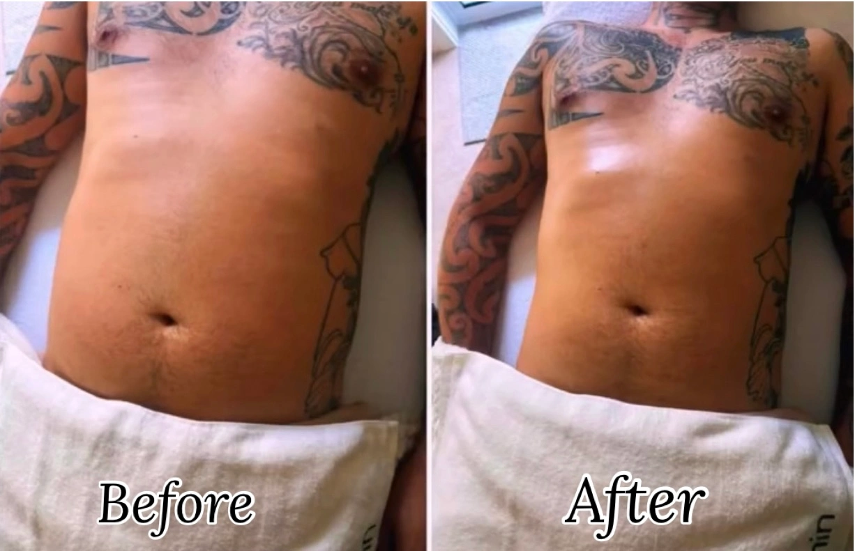Before-and-after client result following lymphatic drainage treatment with Kate.