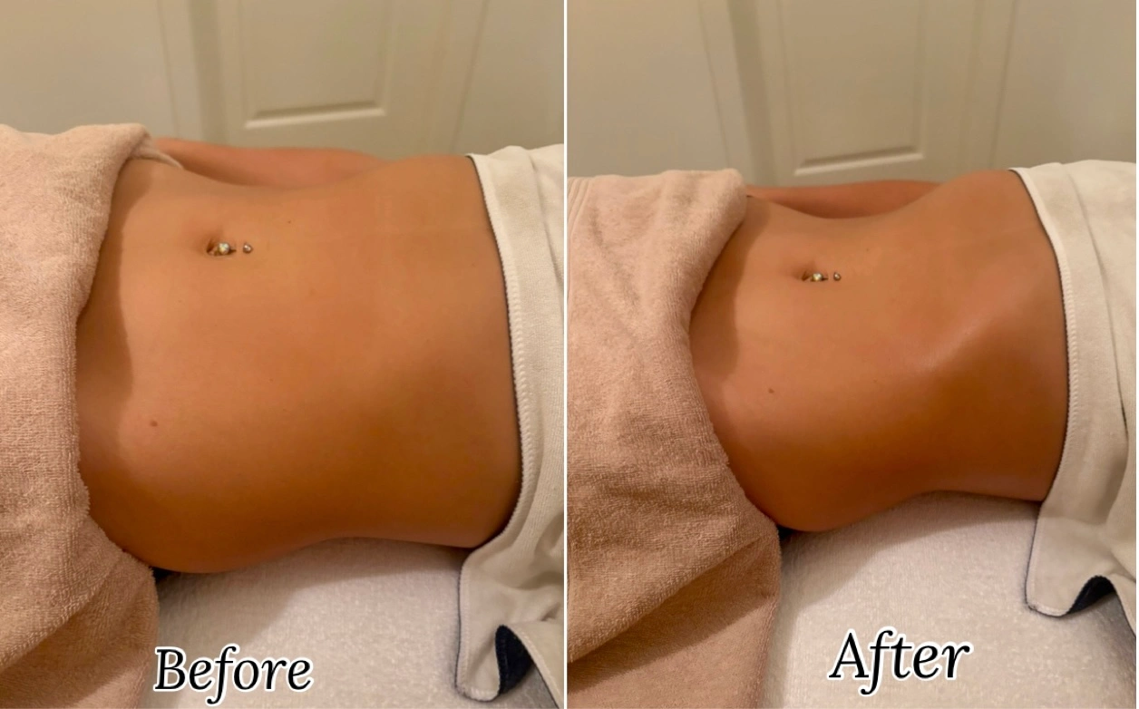 Before and after post-operative lymphatic drainage recovery result at Firmin Fitness and Wellness.