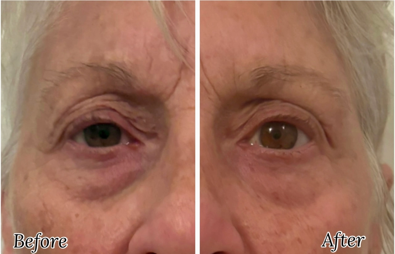 Before and after client result following post-operative lymphatic drainage at Firmin Fitness and Wellness.