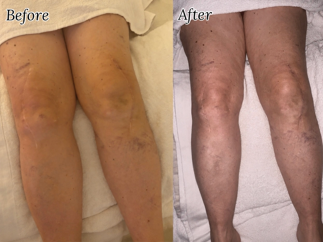 Before and after post-operative lymphatic drainage recovery result at Firmin Fitness and Wellness.