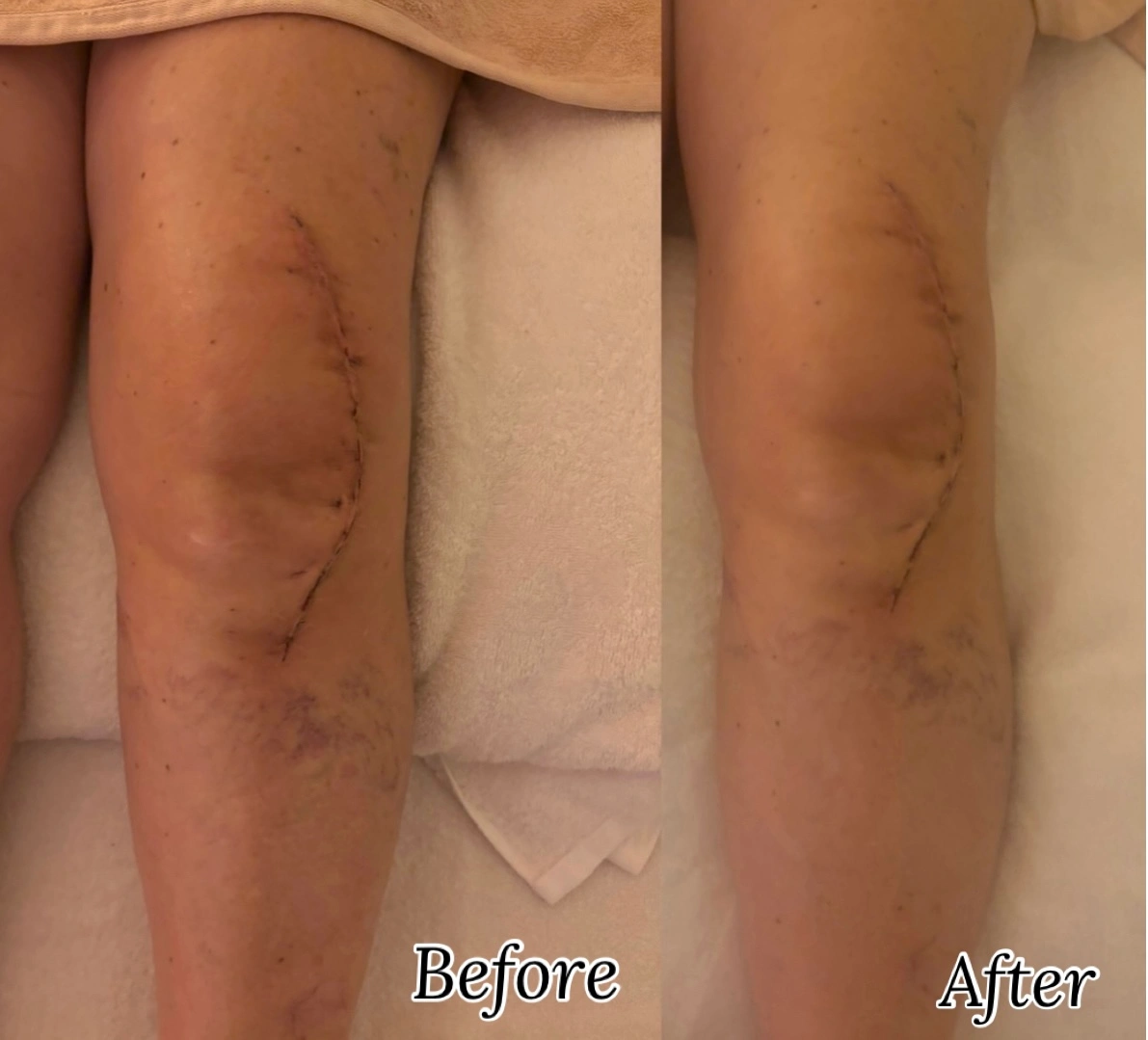 Before and after post-operative lymphatic drainage recovery result at Firmin Fitness and Wellness.