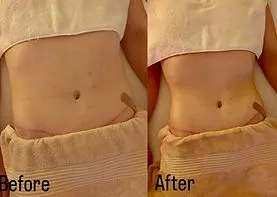Before and after post-operative lymphatic drainage client result, shared with permission.