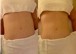 Before and after post-operative lymphatic drainage client result, shared with permission.