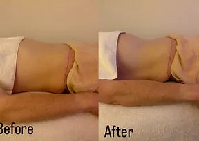 Before and after post-operative lymphatic drainage client result, shared with permission.